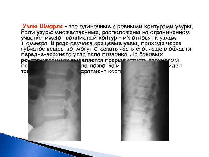 Дефект шморля позвоночника что это