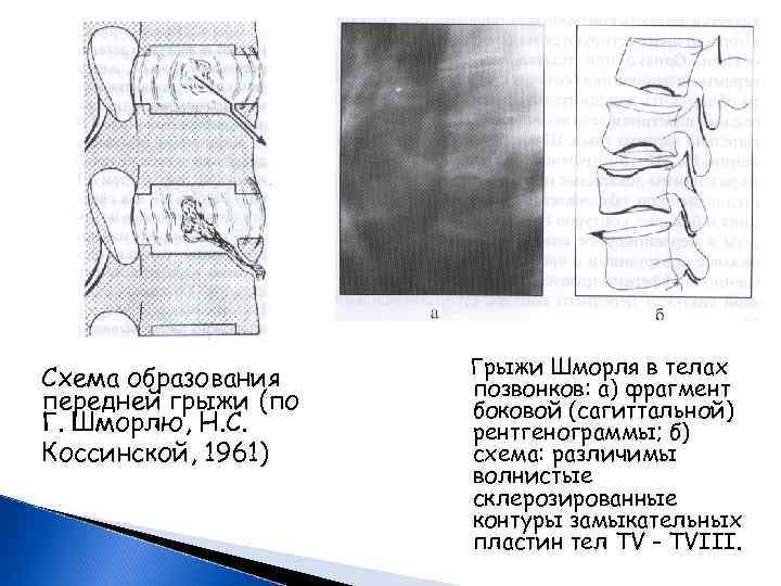 Грыжа казакша презентация