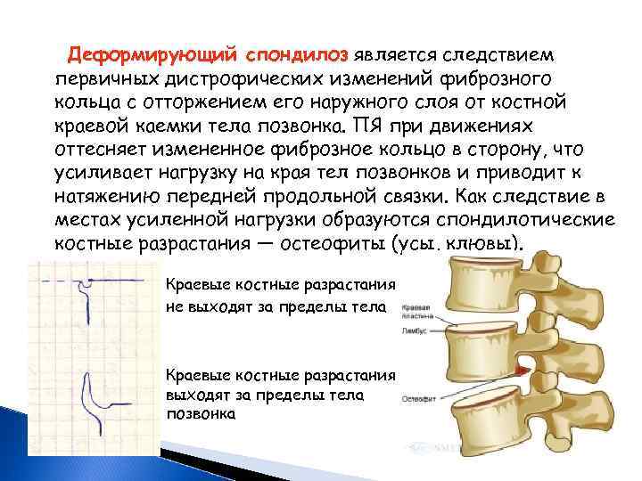  Деформирующий спондилоз является следствием первичных дистрофических изменений фиброзного кольца с отторжением его наружного