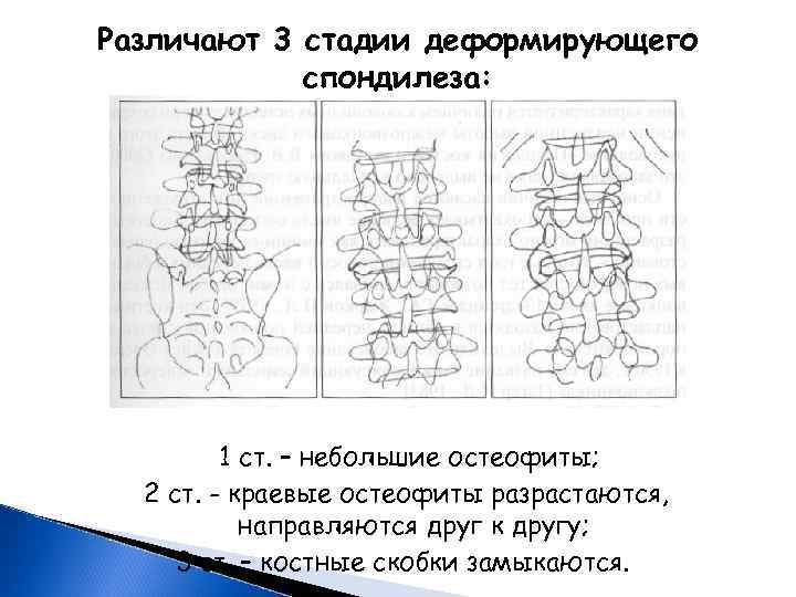 Стадии принятия остеохондроза картинка смешная