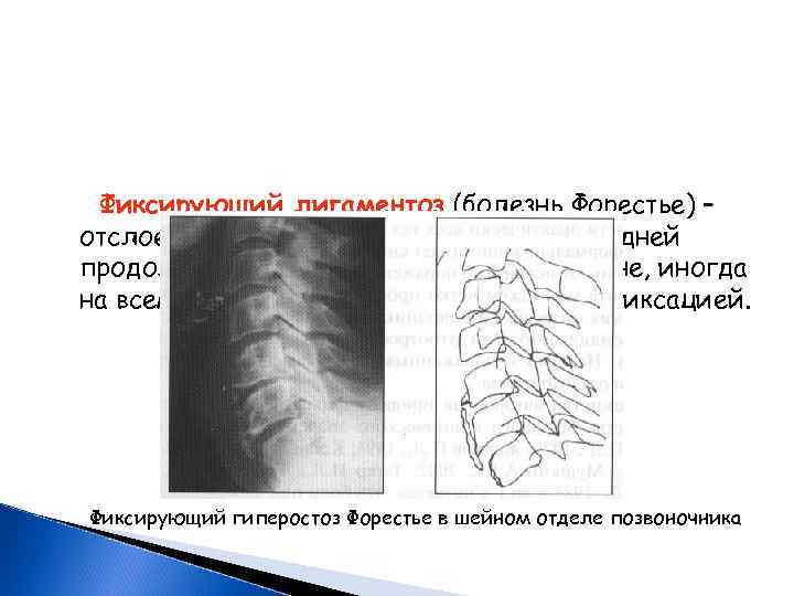 Фиксирующий лигаментоз (болезнь Форестье) – отслоение и сплошная оссификация передней продольной связки на том