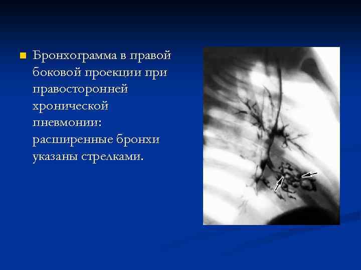 n Бронхограмма в правой боковой проекции правосторонней хронической пневмонии: расширенные бронхи указаны стрелками. 