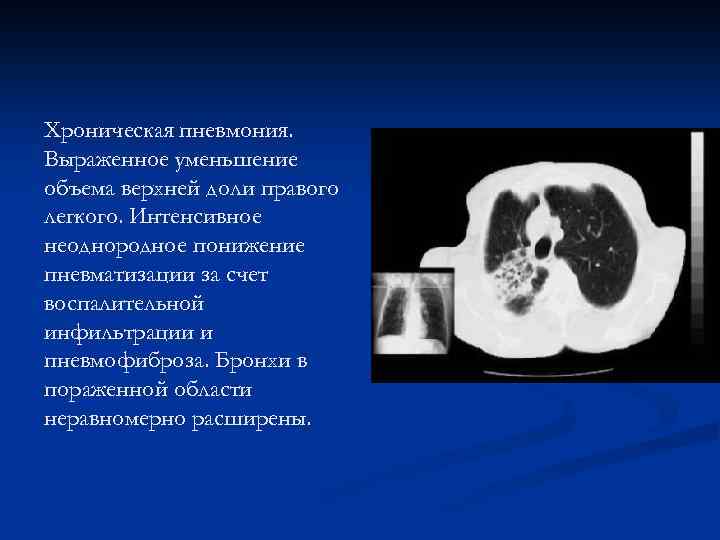 Хроническая пневмония. Выраженное уменьшение объема верхней доли правого легкого. Интенсивное неоднородное понижение пневматизации за
