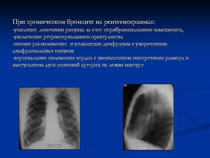 При хроническом бронхите на рентгенограммах: -усиление легочного рисунка за счет перибронхиального компонента, -увеличение ретростернального