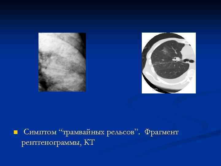 n Симптом “трамвайных рельсов”. Фрагмент рентгенограммы, КТ 