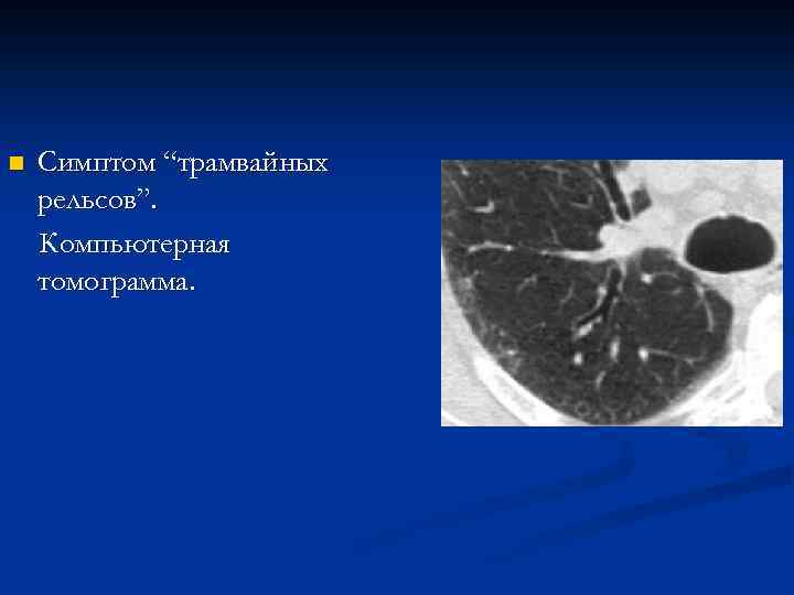 n Симптом “трамвайных рельсов”. Компьютерная томограмма. 