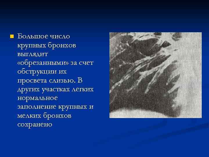 n Большое число крупных бронхов выглядит «обрезанными» за счет обструкции их просвета слизью. В