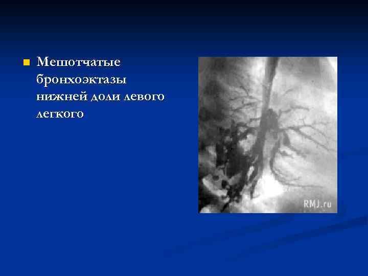 n Мешотчатые бронхоэктазы нижней доли левого легкого 