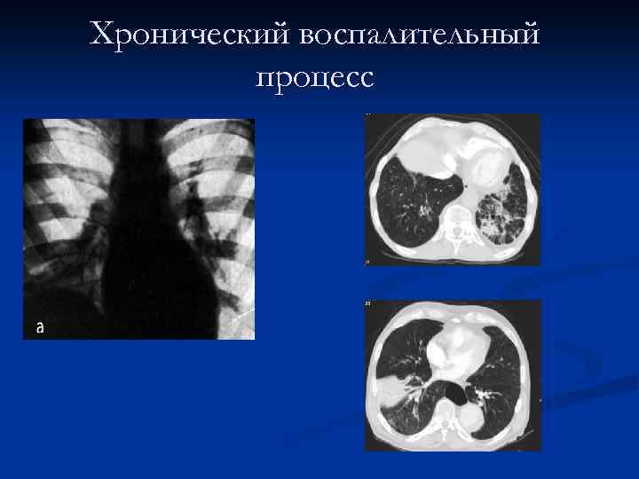 Хронический воспалительный процесс 