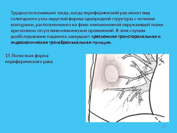 Трудности возникают тогда, когда периферический рак имеет вид солитарного узла округлой формы однородной структуры