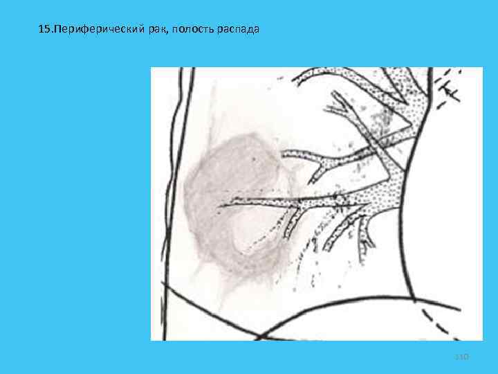 15. Периферический рак, полость распада 110 