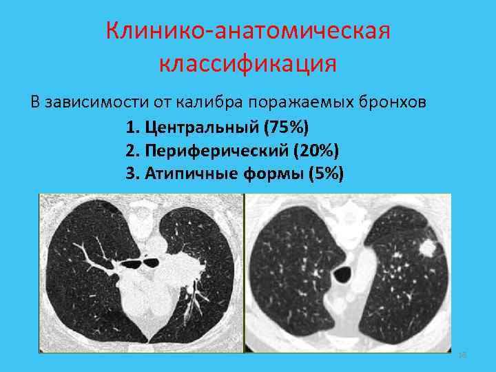 Клинико-анатомическая классификация В зависимости от калибра поражаемых бронхов 1. Центральный (75%) 2. Периферический (20%)