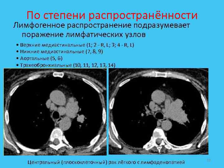 По степени распространённости Лимфогенное распространение подразумевает поражение лимфатических узлов • Верхние медиастинальные (1; 2