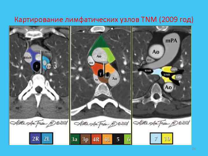 Картирование лимфатических узлов TNM (2009 год) 24 