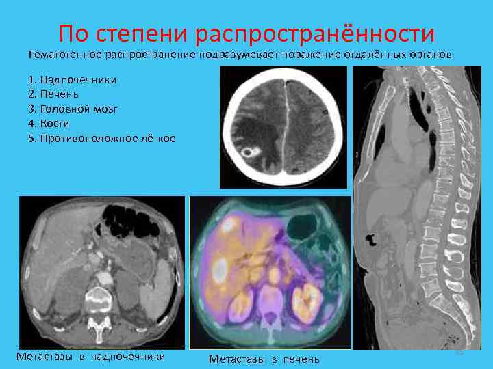 По степени распространённости Гематогенное распространение подразумевает поражение отдалённых органов 1. Надпочечники 2. Печень 3.