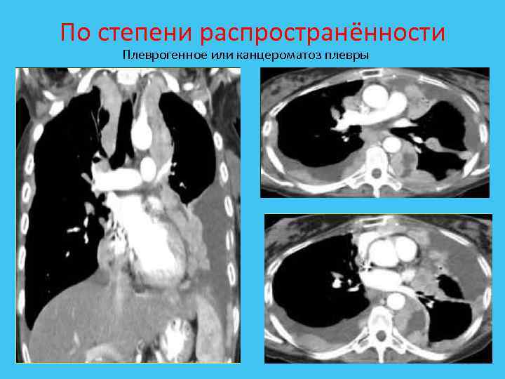 По степени распространённости Плеврогенное или канцероматоз плевры 26 