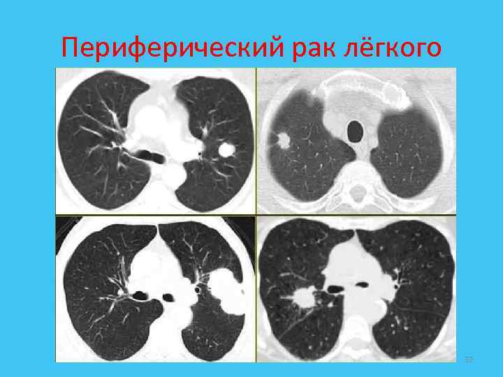 Периферический рак лёгкого 32 