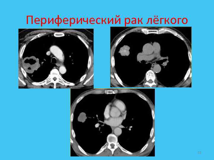 Периферический рак лёгкого 33 