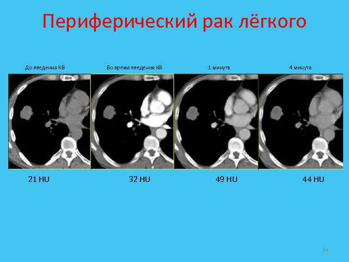 Периферический рак лёгкого До введения КВ Во время введения КВ 1 минута 4 минута