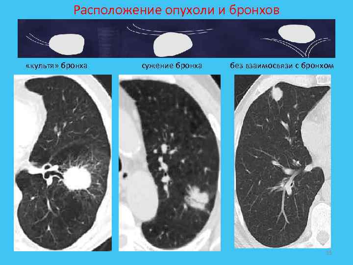 Расположение опухоли и бронхов «культя» бронха сужение бронха без взаимосвязи с бронхом 35 