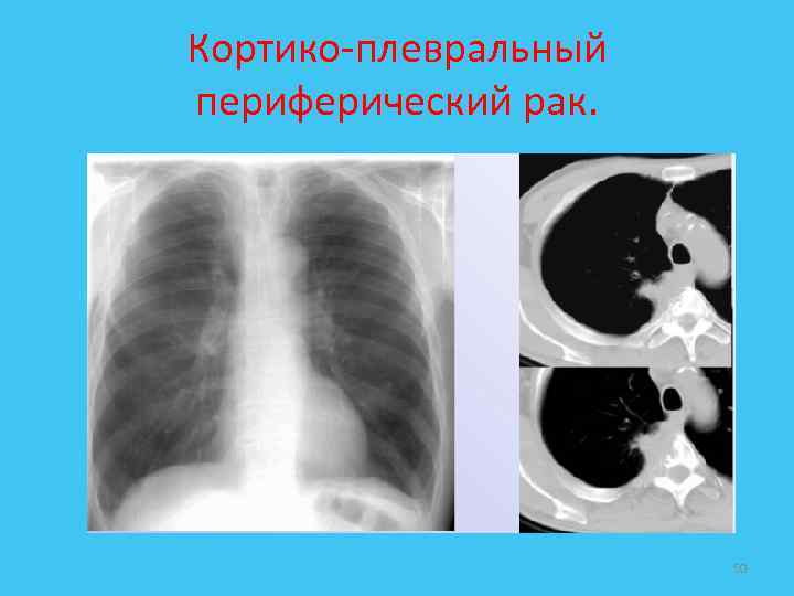 Кортико-плевральный периферический рак. 50 