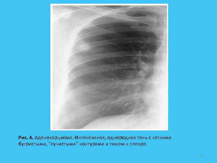 Рис. 4. Аденокарциома. Интенсивная, однородная тень с четкими бугристыми, 