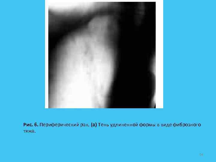 Рис. 6. Периферический рак. (а) Тень удлиненной формы в виде фиброзного тяжа. 64 