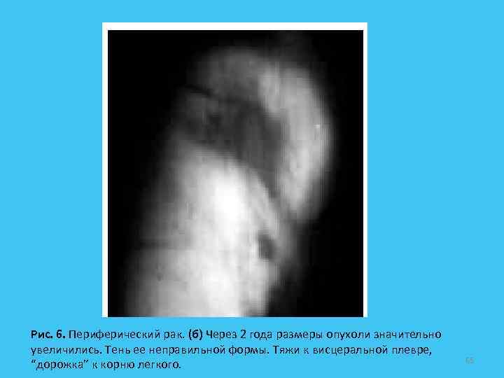 Рис. 6. Периферический рак. (б) Через 2 года размеры опухоли значительно увеличились. Тень ее