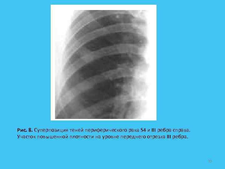 Рис. 8. Суперпозиция теней периферического рака S 4 и III ребра справа. Участок повышенной