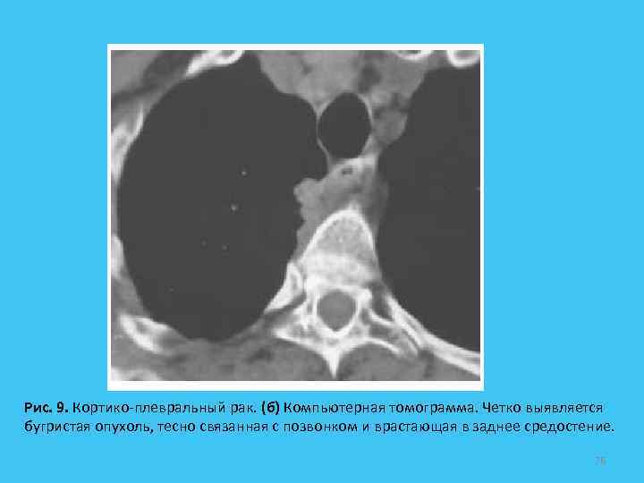 Рис. 9. Кортико-плевральный рак. (б) Компьютерная томограмма. Четко выявляется бугристая опухоль, тесно связанная с
