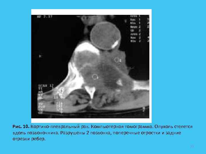 Рис. 10. Кортико-плевральный рак. Компьютерная томограмма. Опухоль стелется вдоль позвоночника. Разрушены 2 позвонка, поперечные