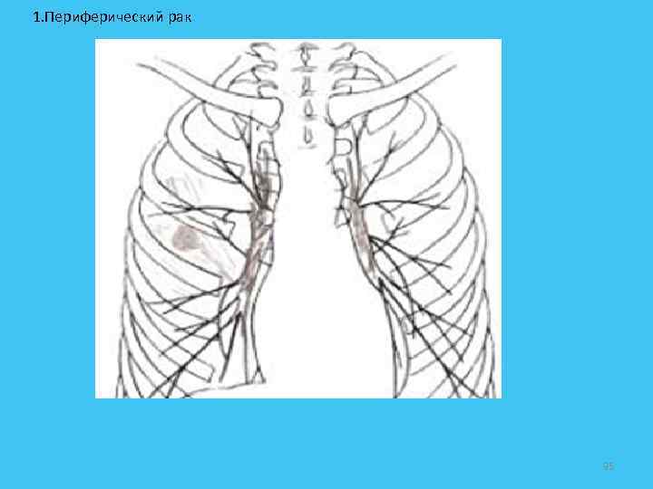  1. Периферический рак 95 