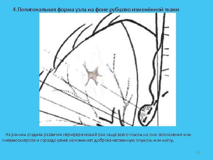  4. Полигональная форма узла на фоне рубцово изменённой ткани На ранних стадиях развития