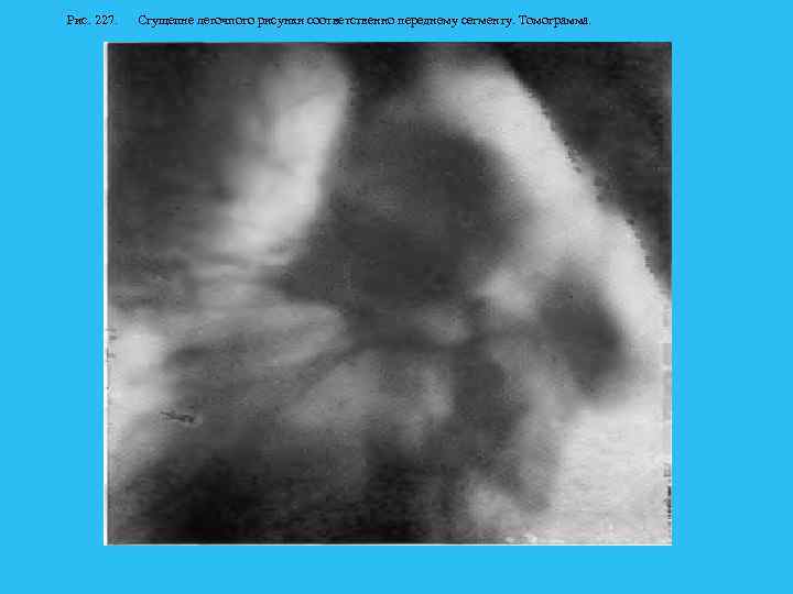 Рис. 227. Сгущепне легочпого рисунки соответственно переднему сегменту. Томограмма. 