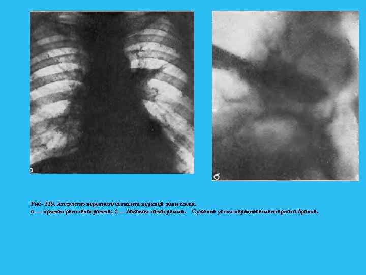 Рис 229. Ателектаз переднего сегмента верхней доли слева. а — прямая рентгенограмма; 6 —