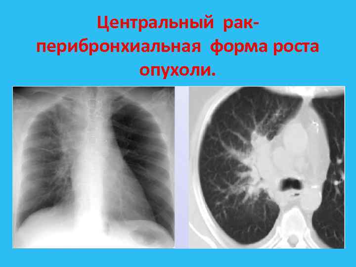 Центральный рак перибронхиальная форма роста опухоли. 