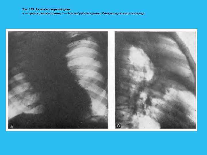 Рис. 235. Ателектаз нерхней доли. а — прямая рентгенограмма; 6 — боковпя'ренттенограмма. Смещение дачи