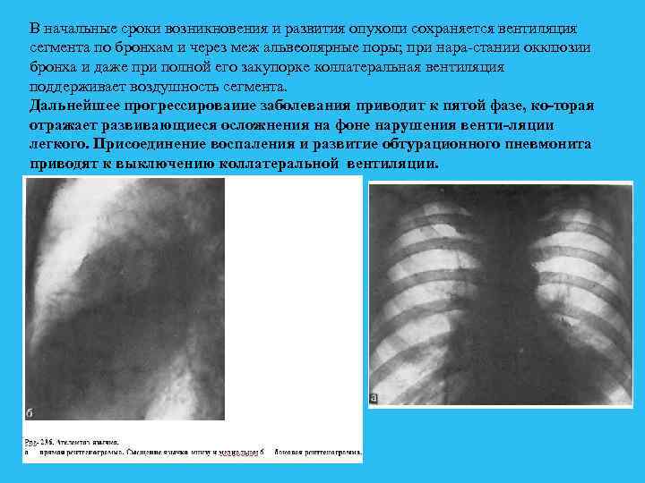 В начальные сроки возникновения и развития опухоли сохраняется вентиляция сегмента по бронхам и через