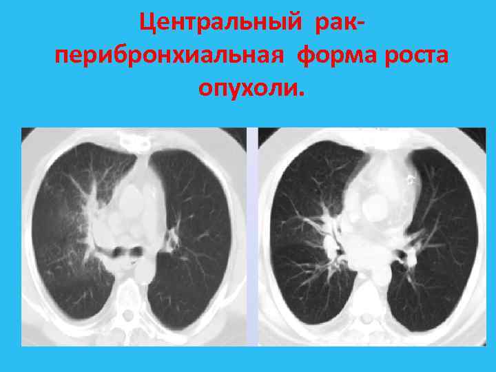 Центральный рак перибронхиальная форма роста опухоли. 
