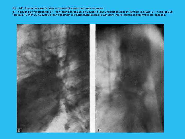 Рис. 245. Ателектаз язычка. Узел в корневой зоне отчетливо не виден. а — прямая
