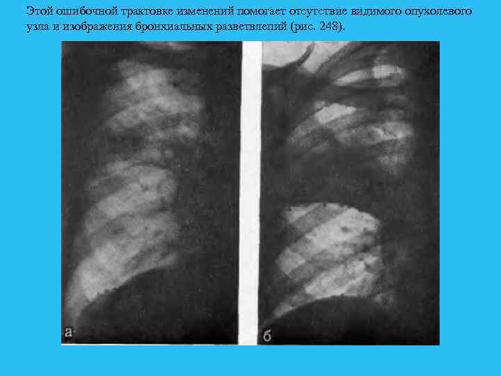 Этой ошибочной трактовке изменений помогает отсутствие видимого опухолевого узла и изображения бронхиальных разветвлепий (рис.