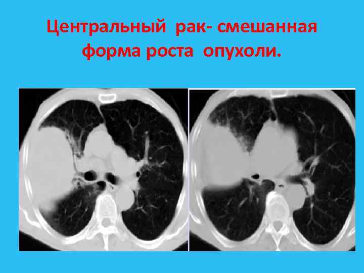 Центральный рак смешанная форма роста опухоли. 