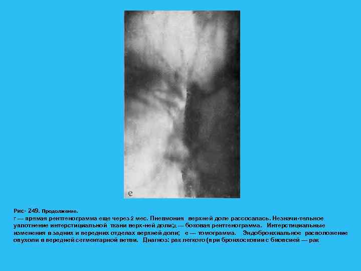 Рис- 249. Продолжение. Г — прямая рентгенограмма еще через 2 мес. Пневмония верхней доле