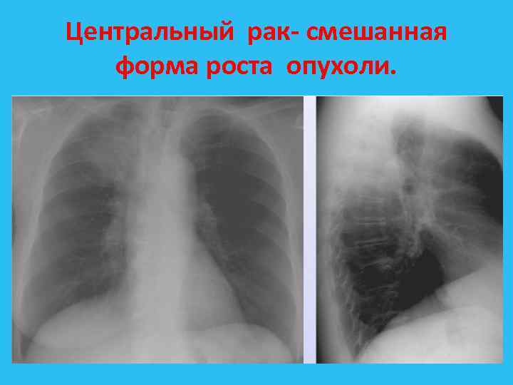 Центральный рак смешанная форма роста опухоли. 