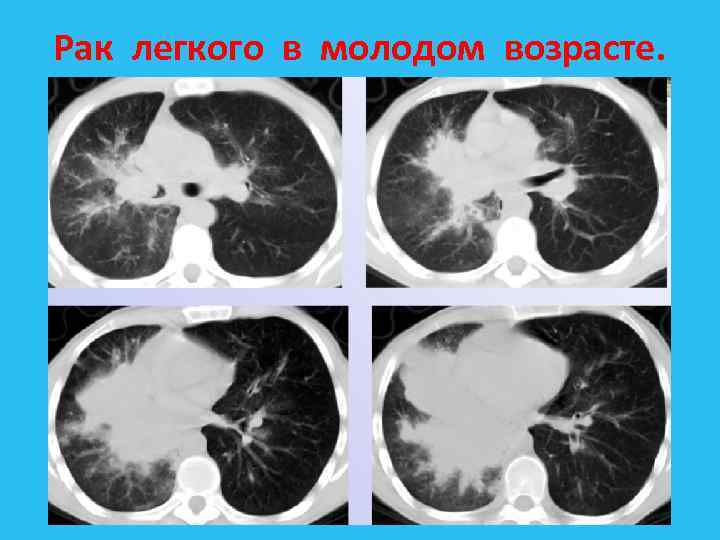 Рак легкого в молодом возрасте. 