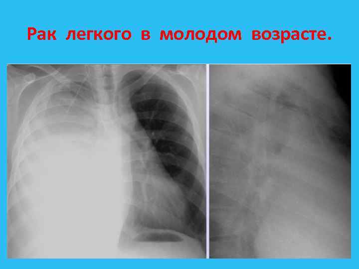 Рак легких 8 класс презентация