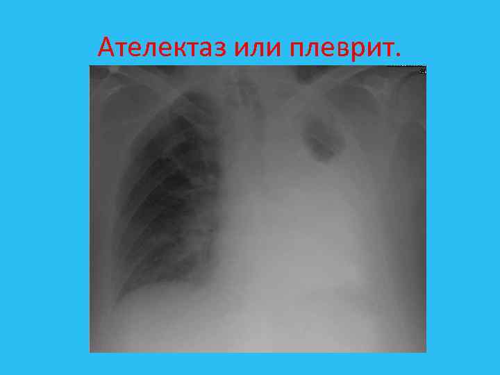 Ателектаз или плеврит. 