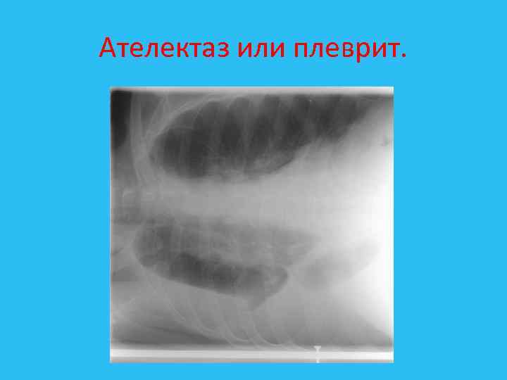 Ателектаз или плеврит. 
