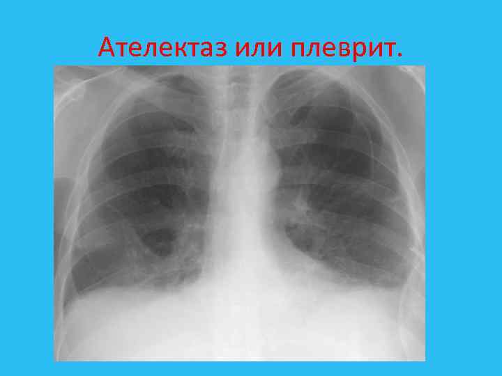 Ателектаз или плеврит. 