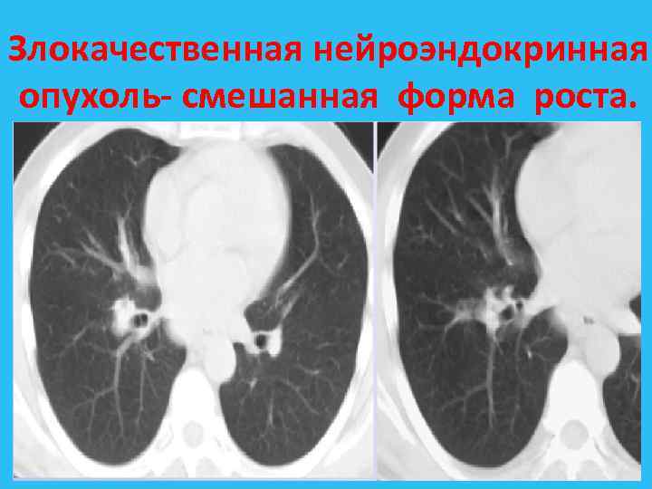 Злокачественная нейроэндокринная опухоль смешанная форма роста. 